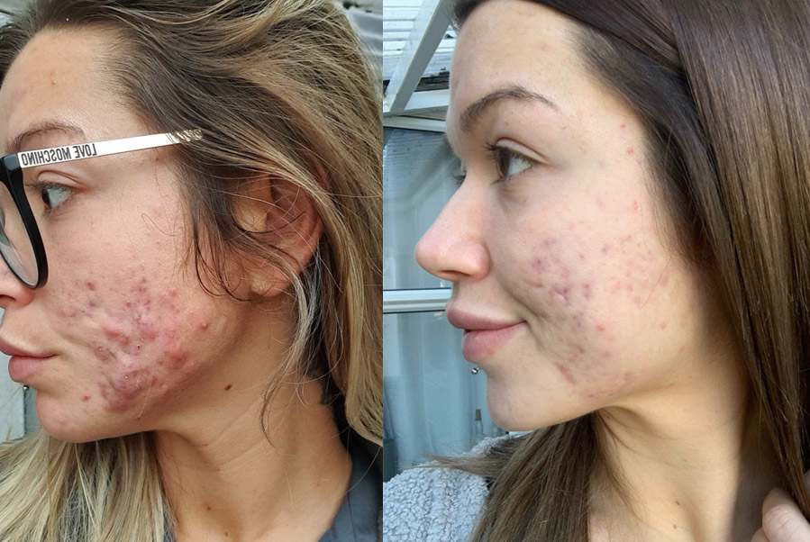 THE GUT-SKIN CONNECTION – 3 MONTH CYSTIC ACNE SKIN TRIAL – A PATIENT’S JOURNEY WITH TOTALLY DERMA<sup>®</sup>